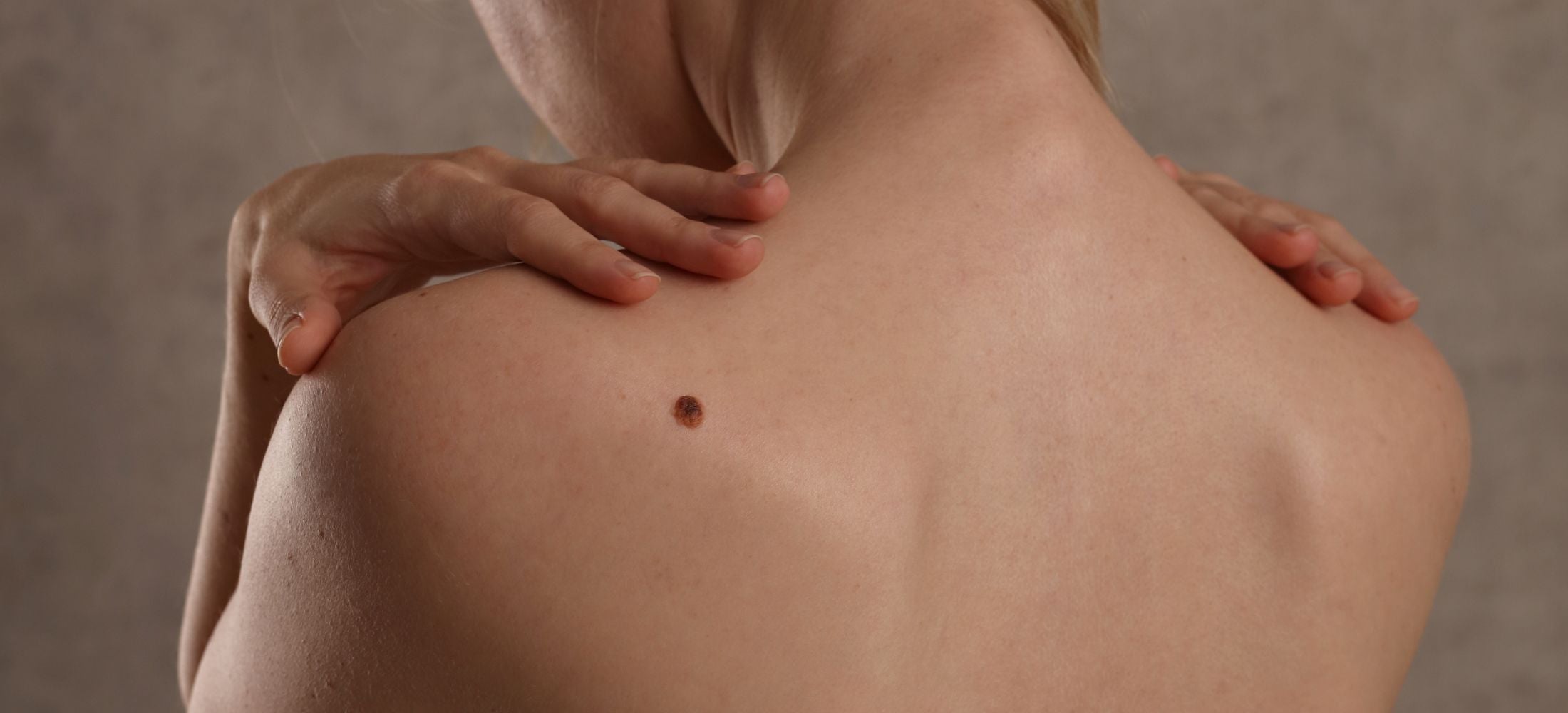 Skin Tag Removal at Beauty Secrets