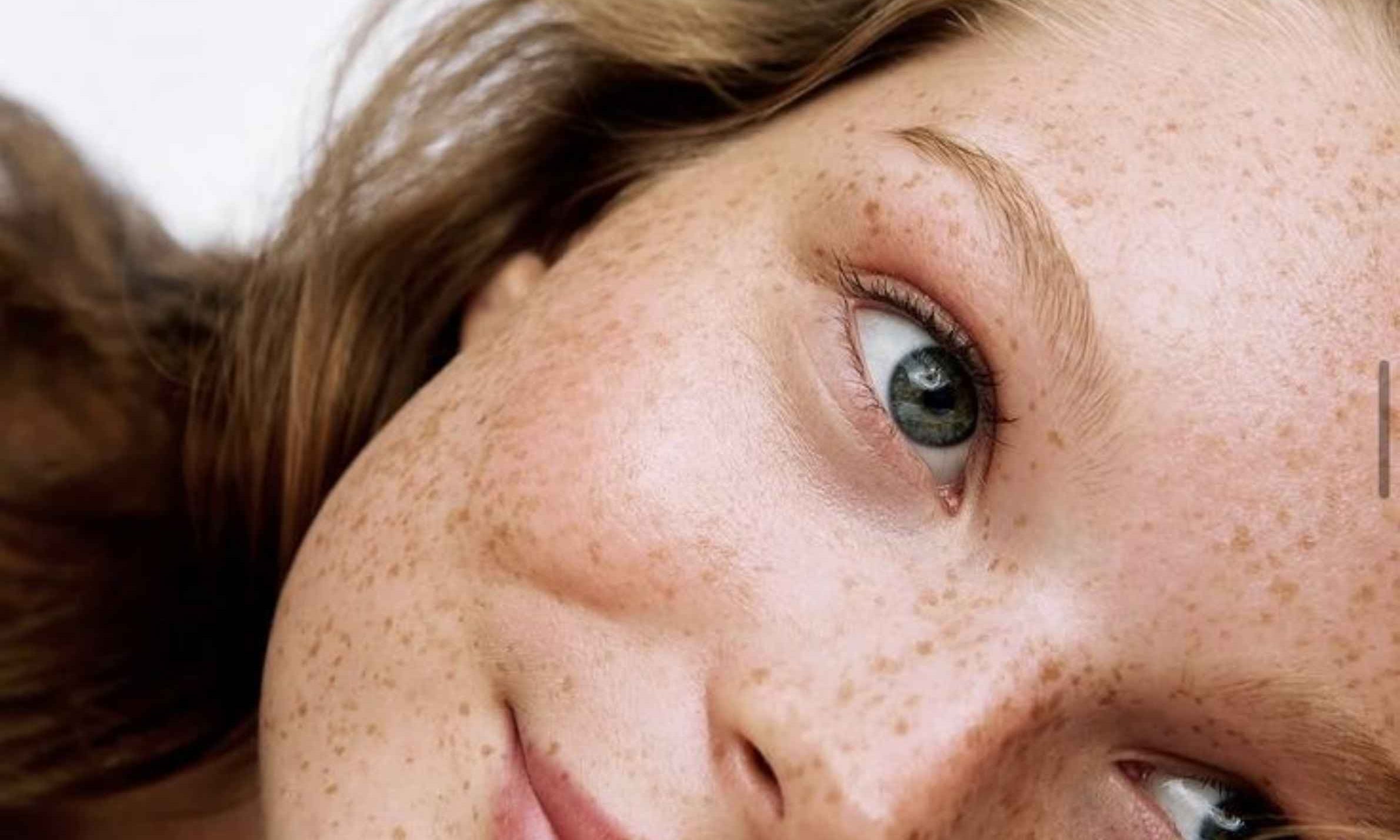teenage skin