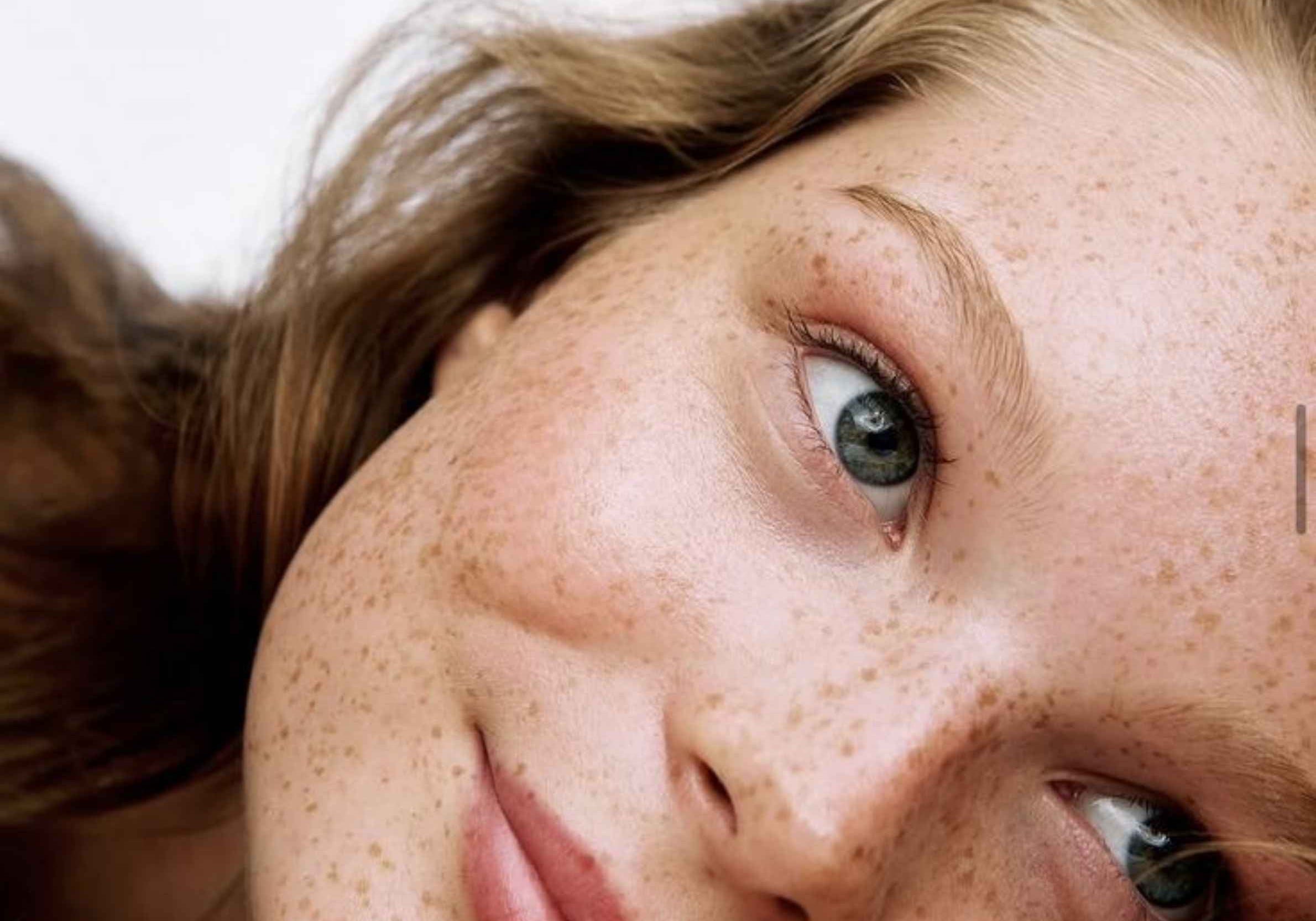 teenage skin